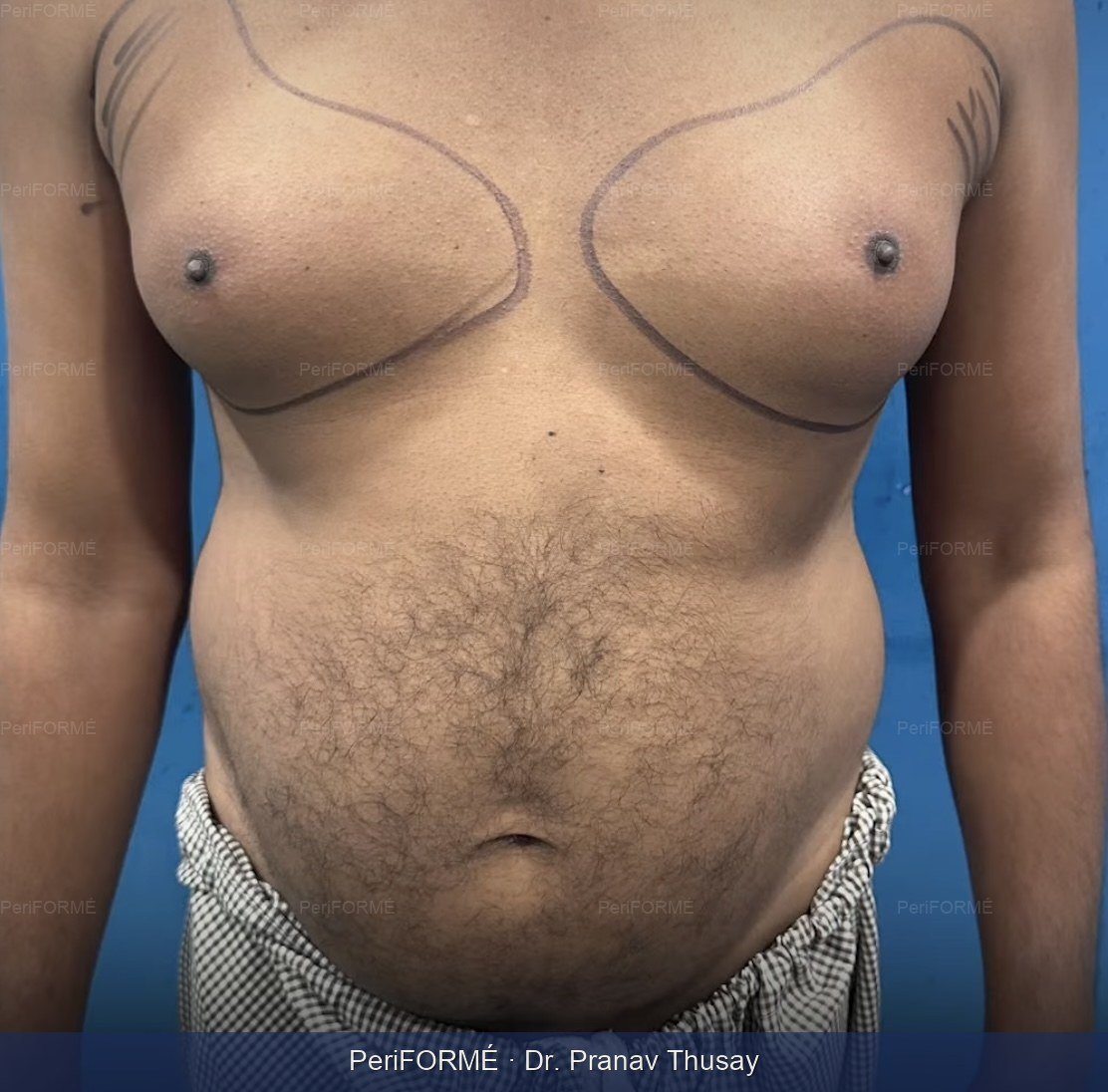 Gynaecomastia liposuction scarless — Before