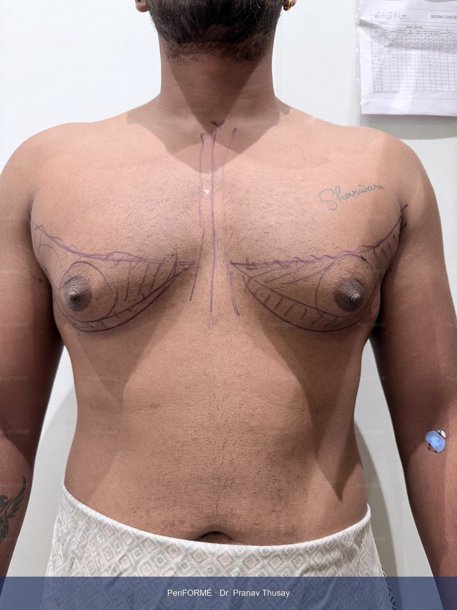 Gynaecomastia - Liposuction surgical markings