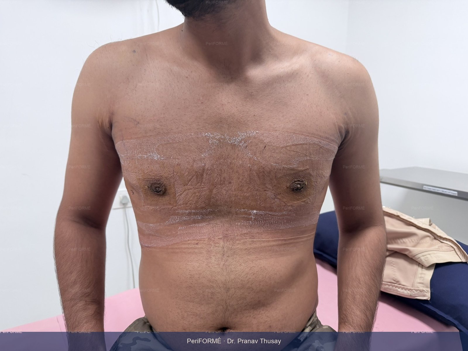 Gynaecomastia surgery - Liposuction — After