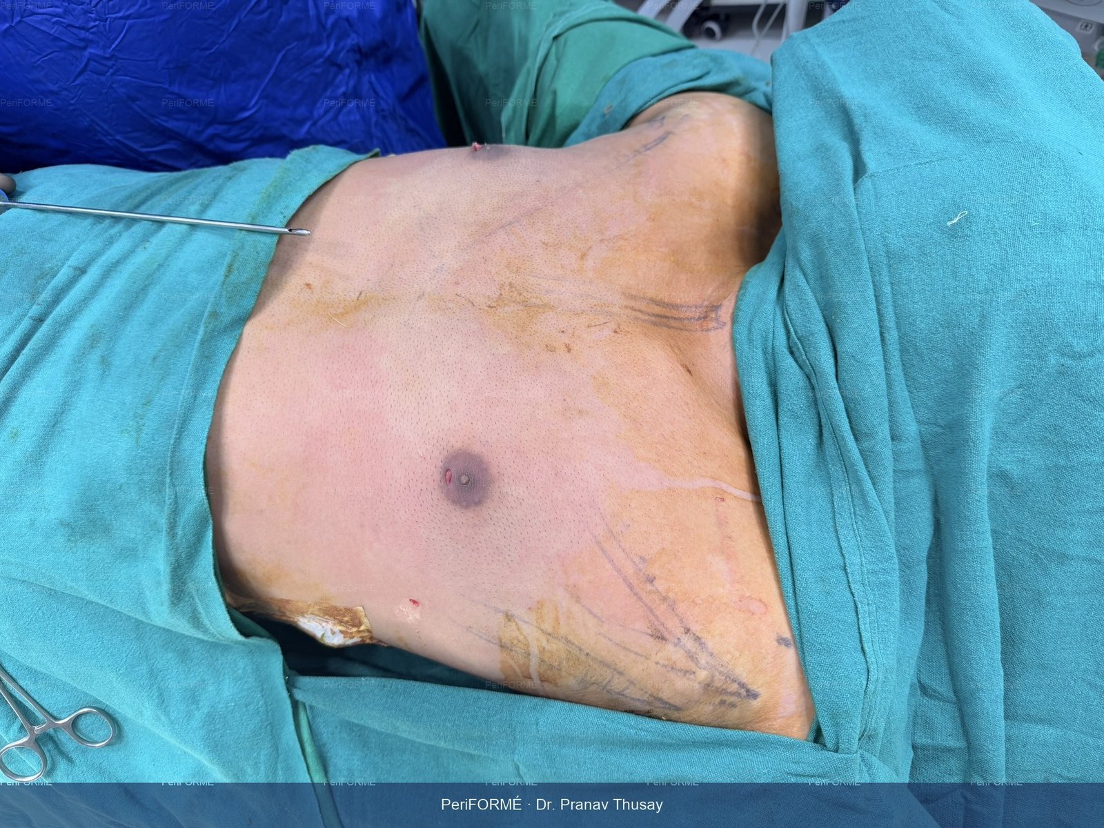 Gynaecomastia surgery -liposuction — After