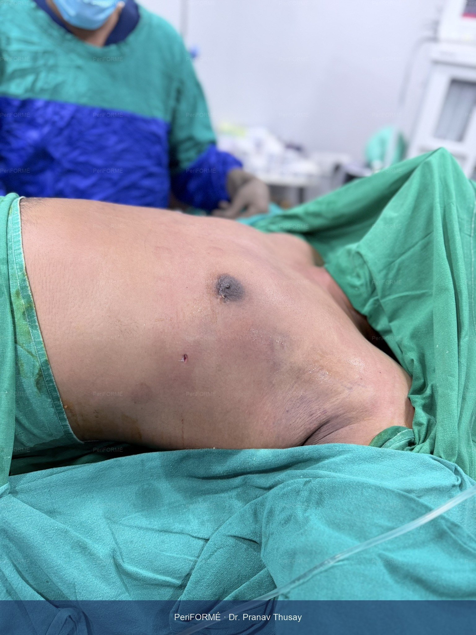 Gynaecomastia surgery - Liposuction — After