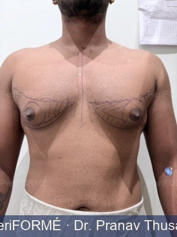 Gynaecomastia surgery - Liposuction — Before