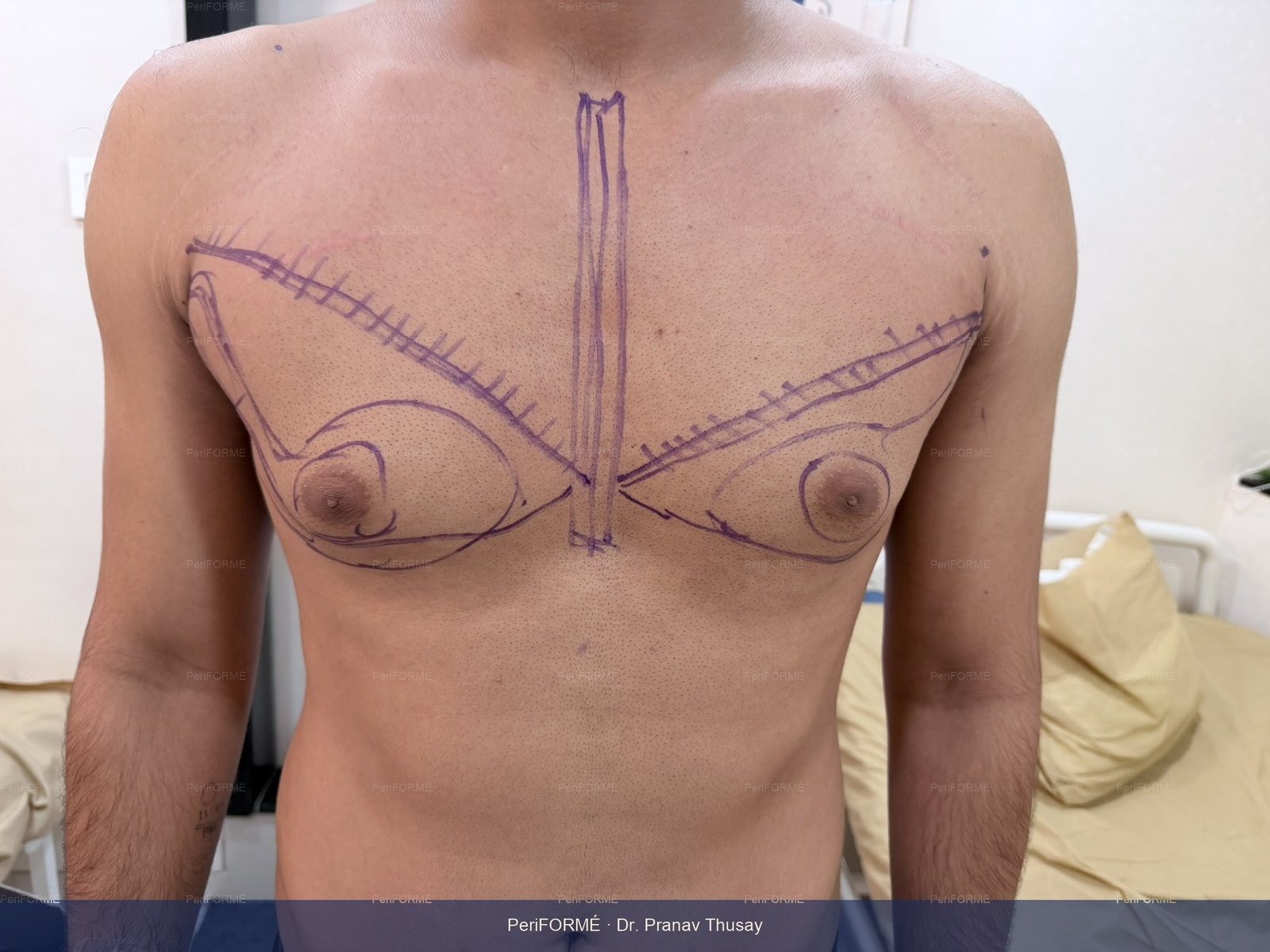 Gynaecomastia surgery -liposuction — Before