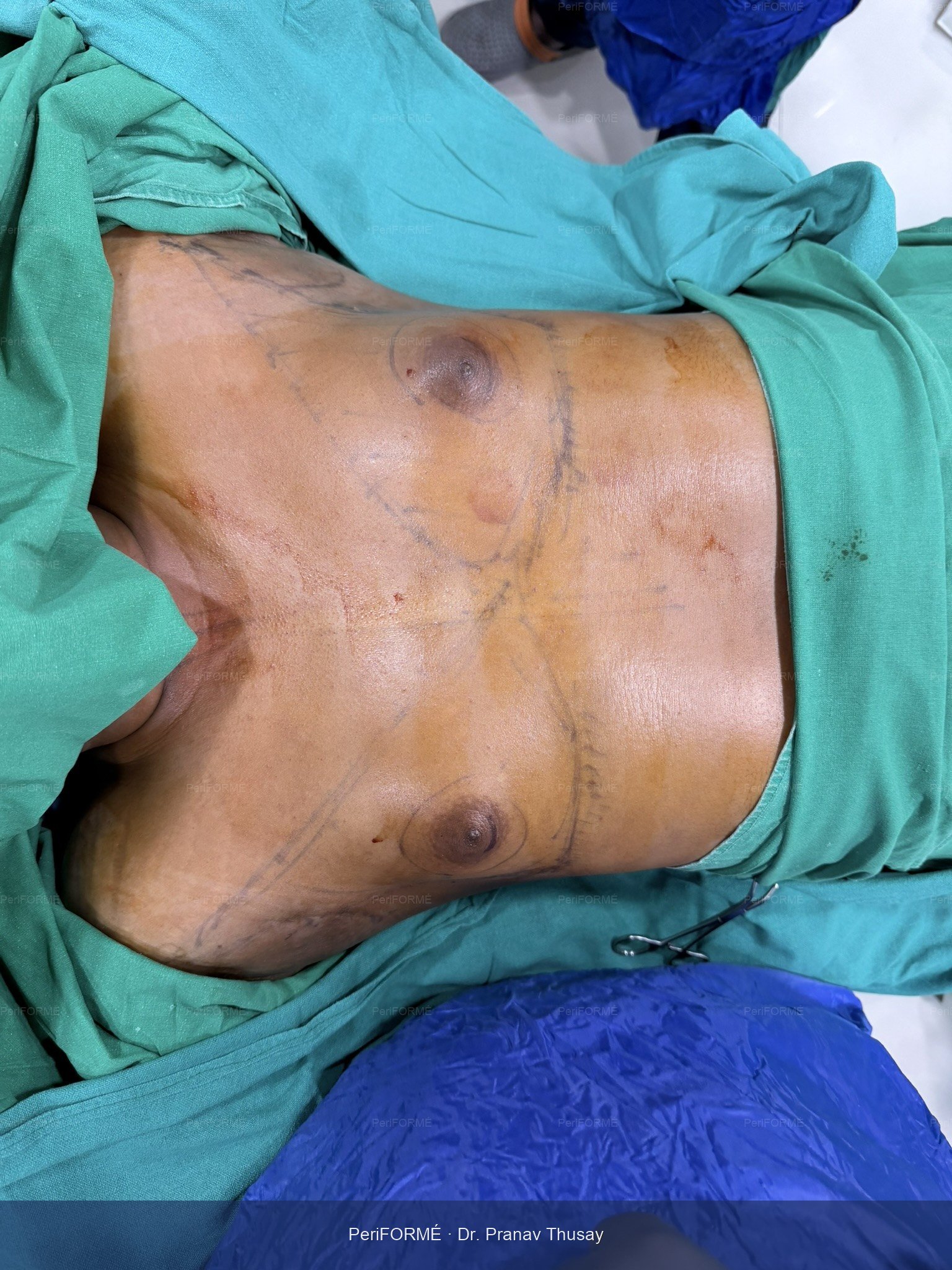 Gynaecomastia surgery - Liposuction — Before