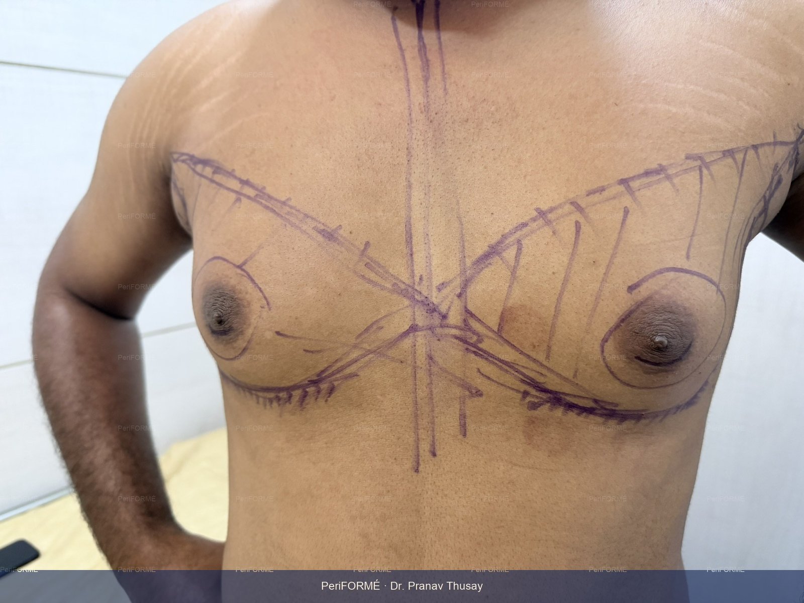 Gynaecomastia surgery planning