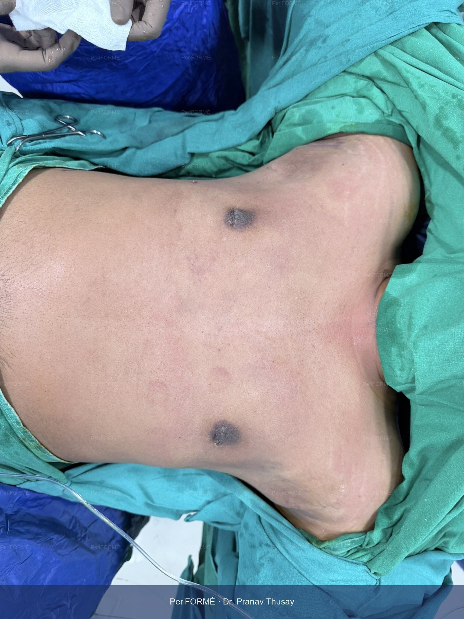 Gynecomastia Surgery Result