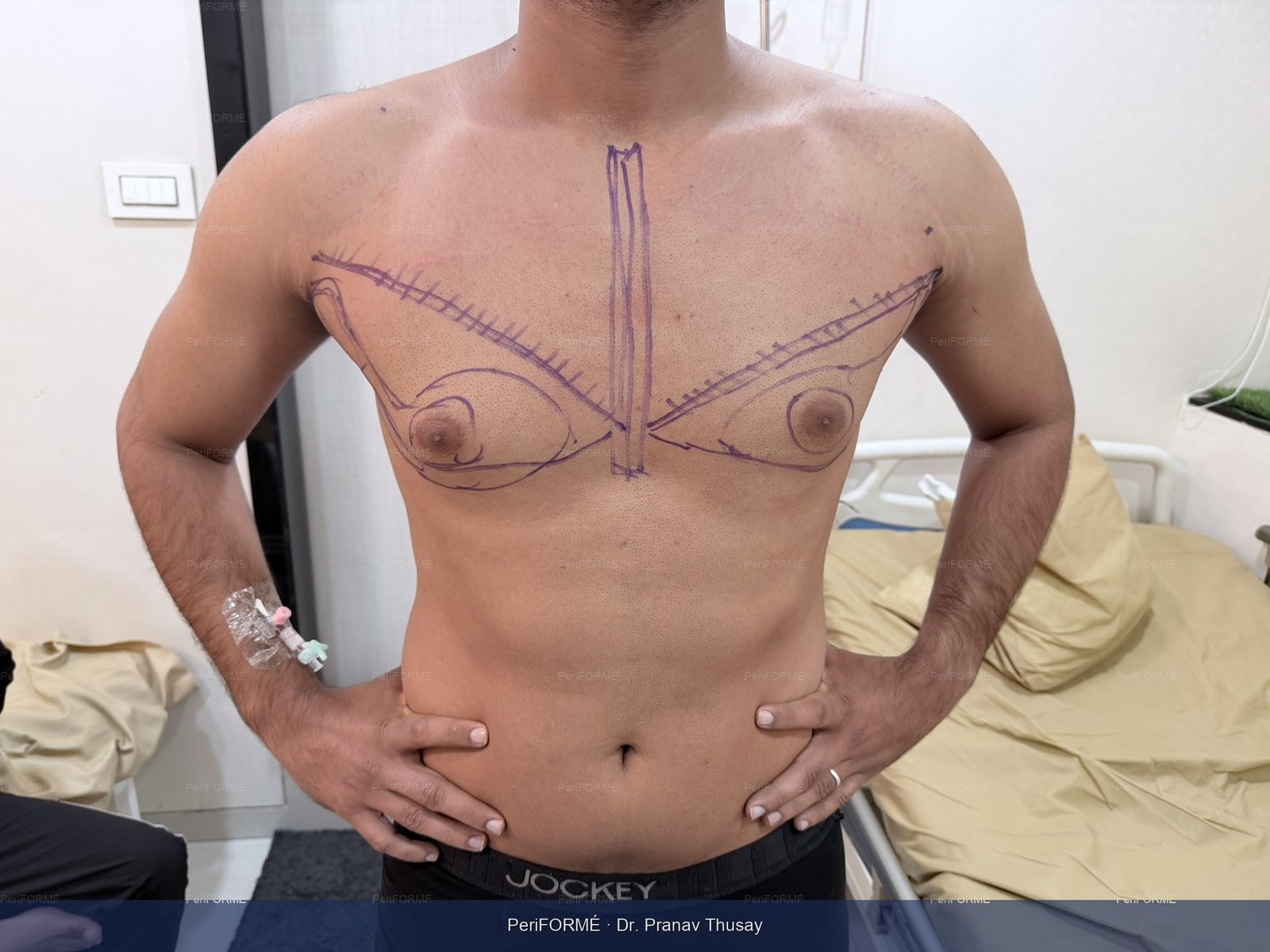 Gynaecomastia surgical markings