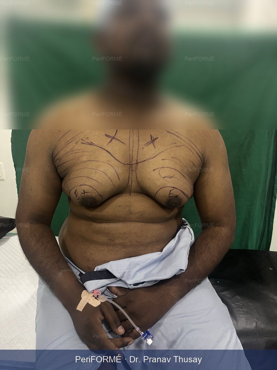 Gynecomastia pre-operative markings
