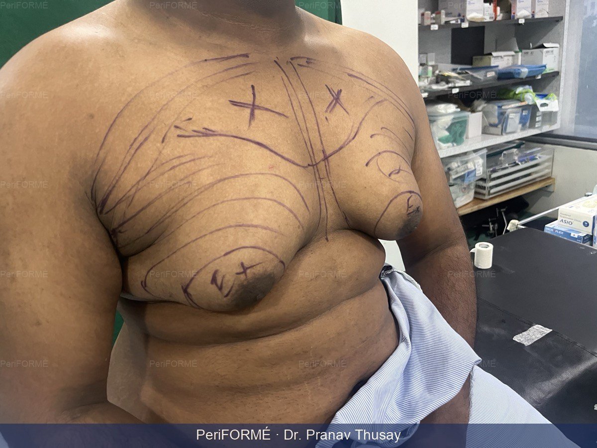 Gynecomastia surgical markings