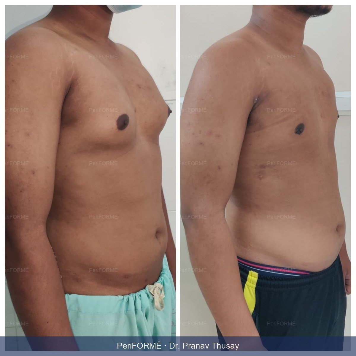 Gynecomastia before and after result