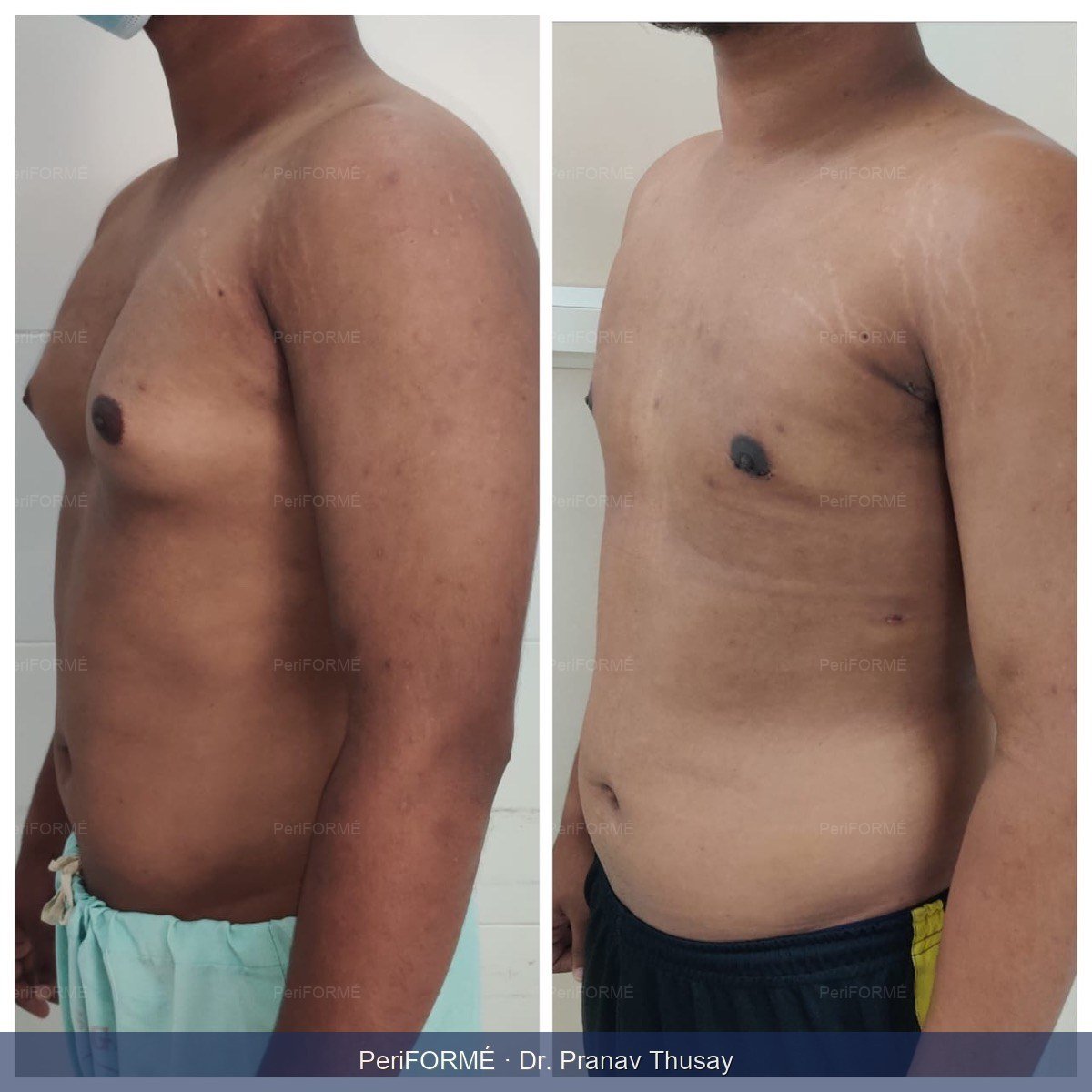 Gynecomastia result case 2