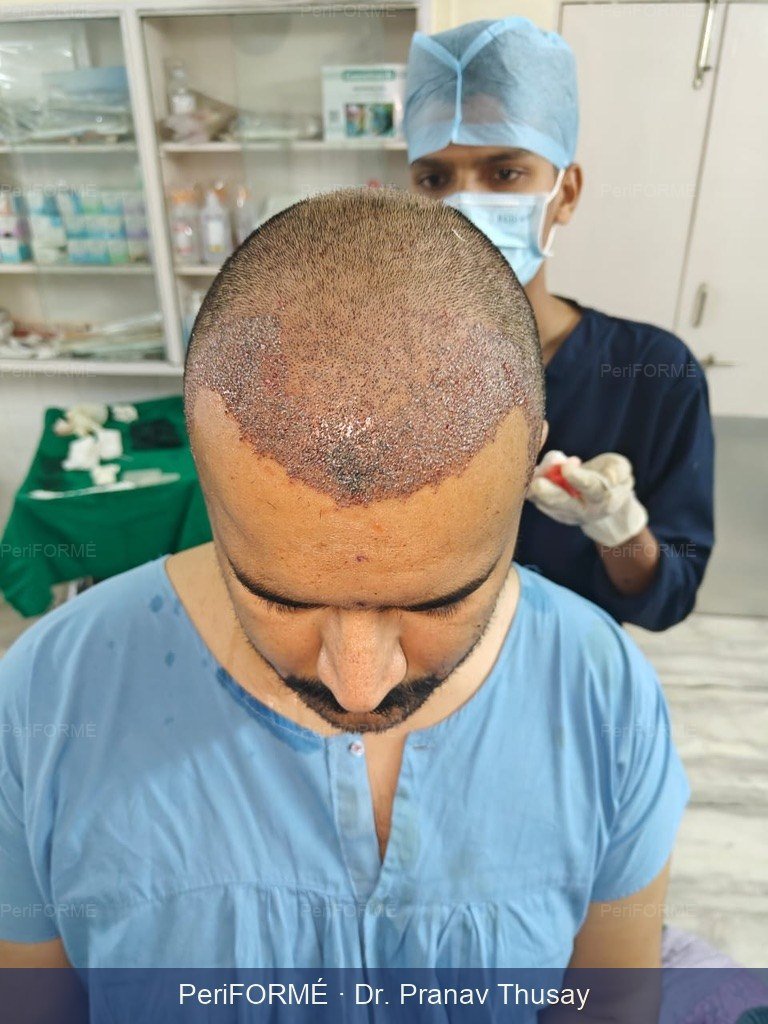 Hair transplant - on table result — After