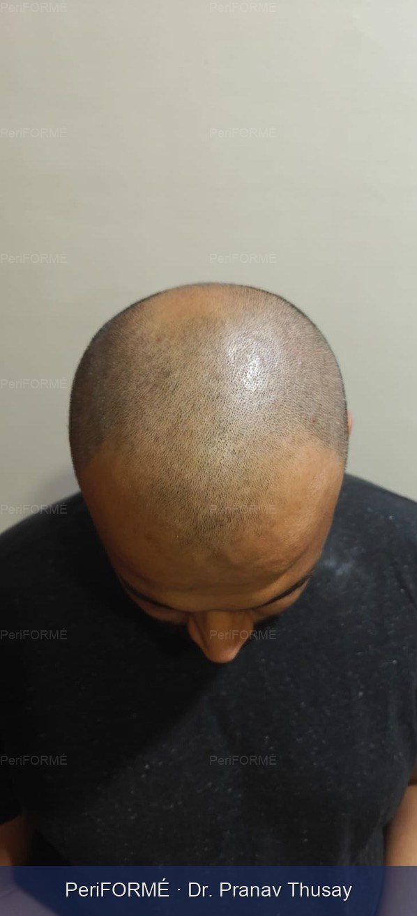 Hair transplant - on table result — Before