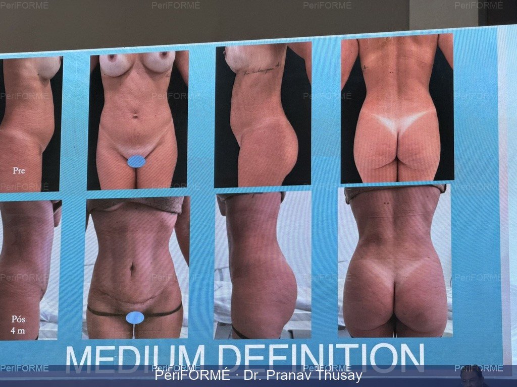 HD liposuction and Body Countouring