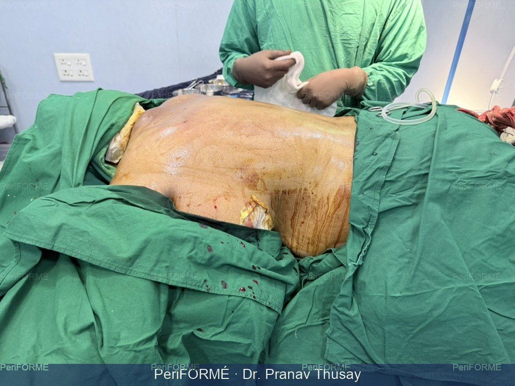 Hump back - liposuction (Scarless) — After