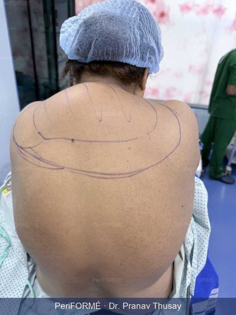 Hump back - liposuction (Scarless) — Before