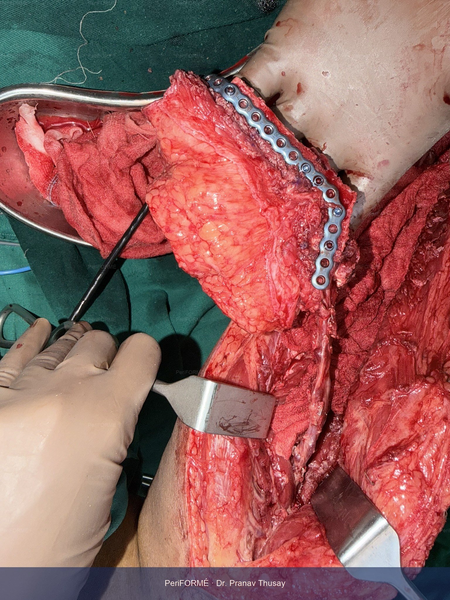 jaw bone creation from leg bone to reconstruct the jaw tissue