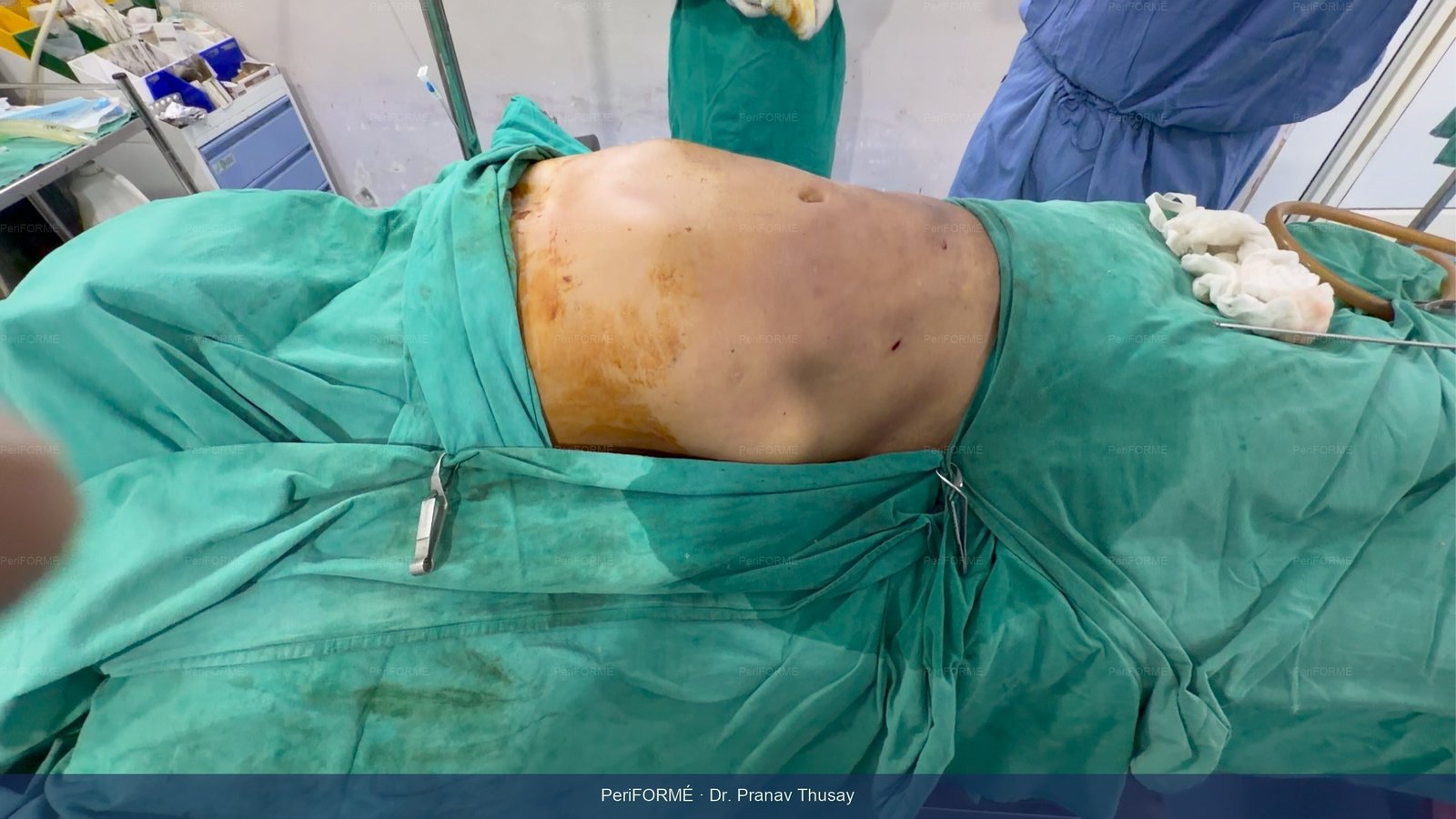 Liposuction abdomen - flat stomach