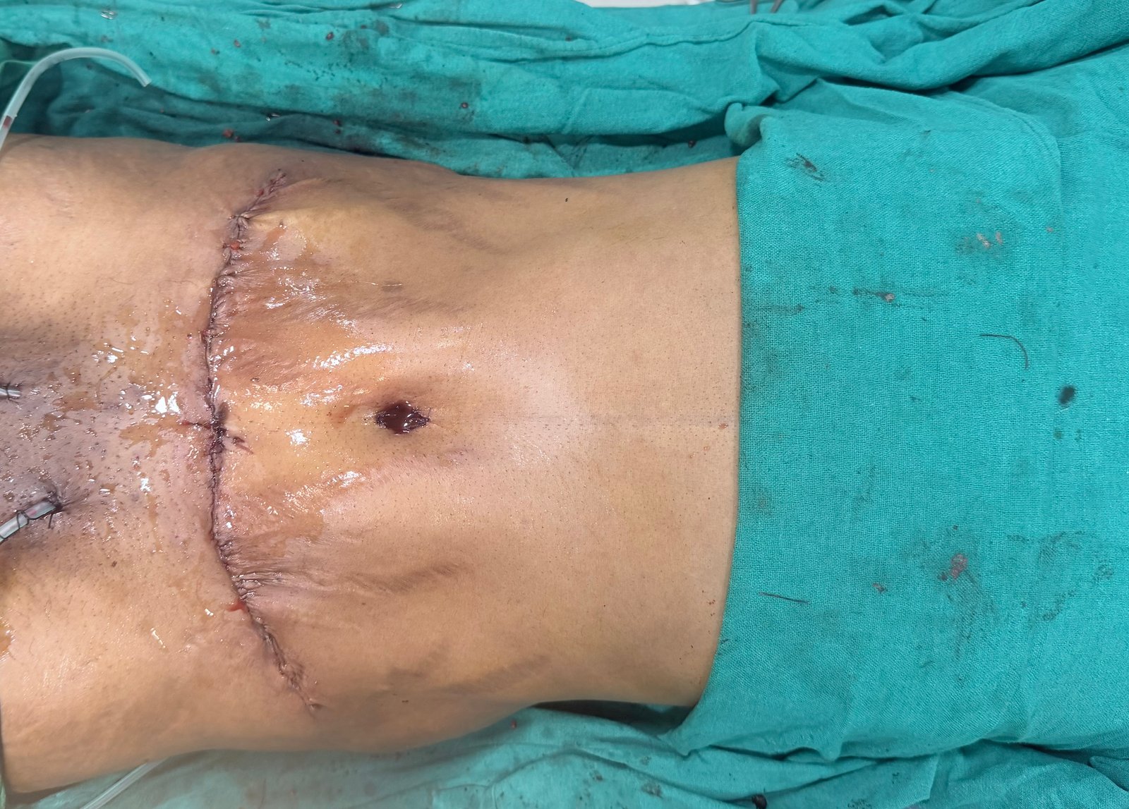 Liposuction and Tummy tuck -post massive weight loss — After