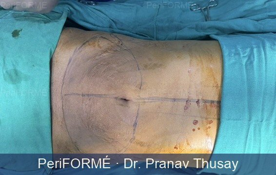 Liposuction and Tummy tuck -post massive weight loss — Before