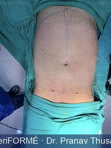 Liposuction - on table result — After