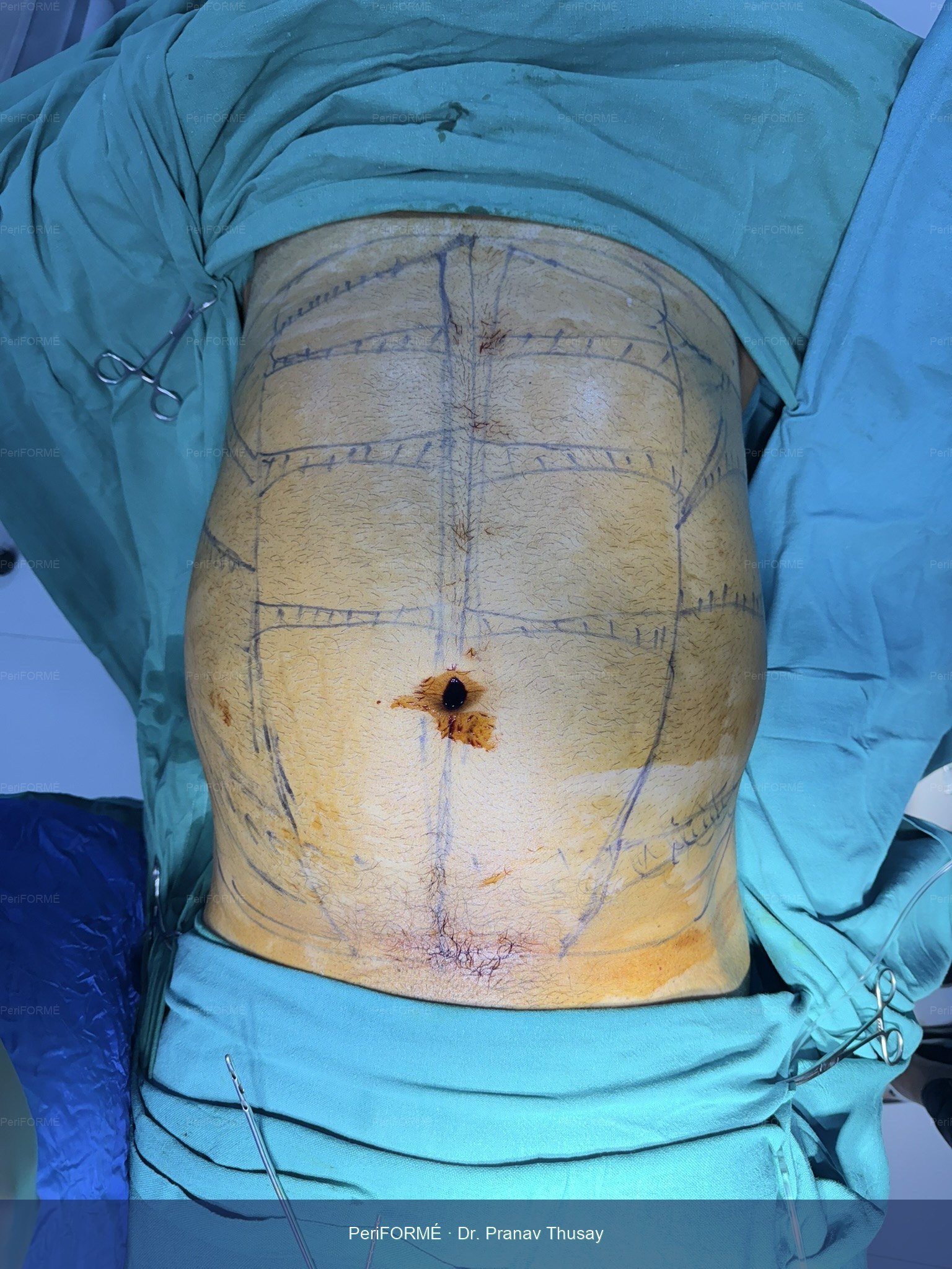 Liposuction - on table result — Before