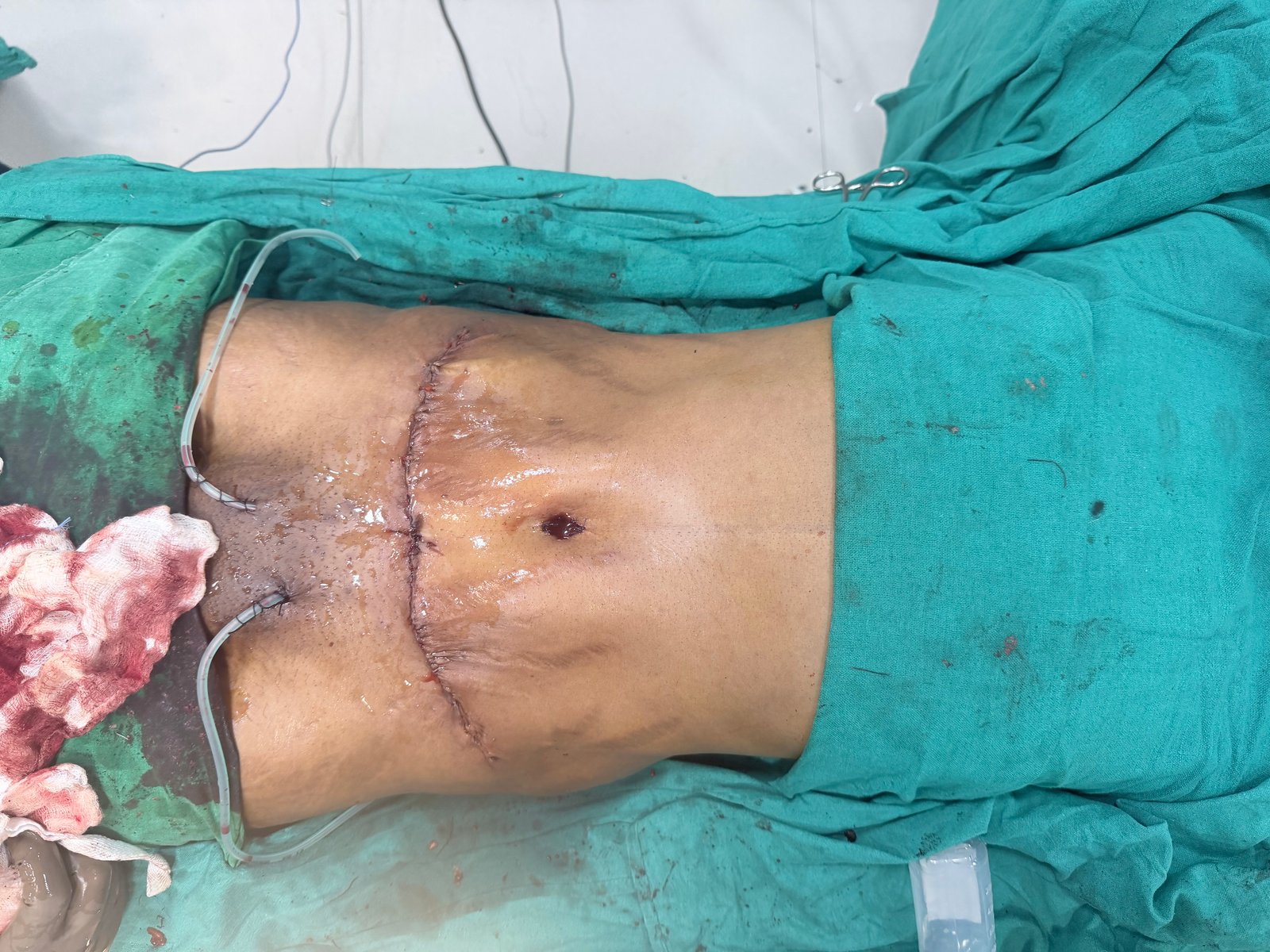 Tummy Tuck After
