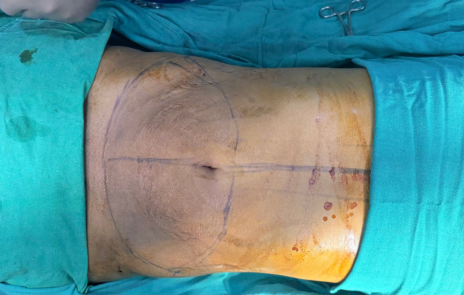Tummy Tuck Before