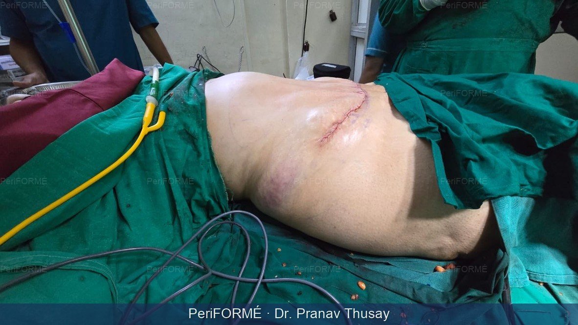 Liposuction +Tummy tuck surgery — After