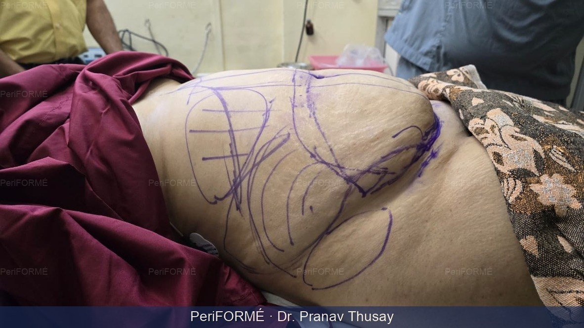 Liposuction +Tummy tuck surgery — Before