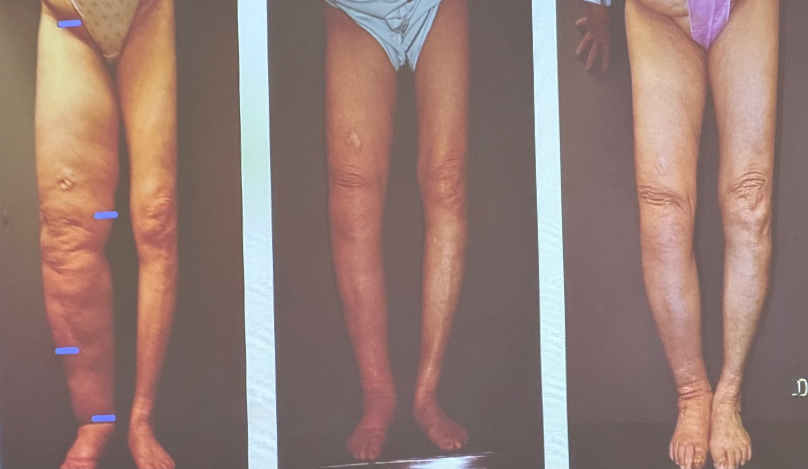 Lymphedema before and after