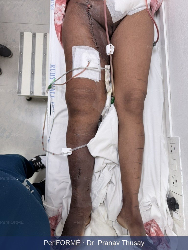 Lymphedema surgery - reduction in lower limb circumference and improvement in quality of life — After
