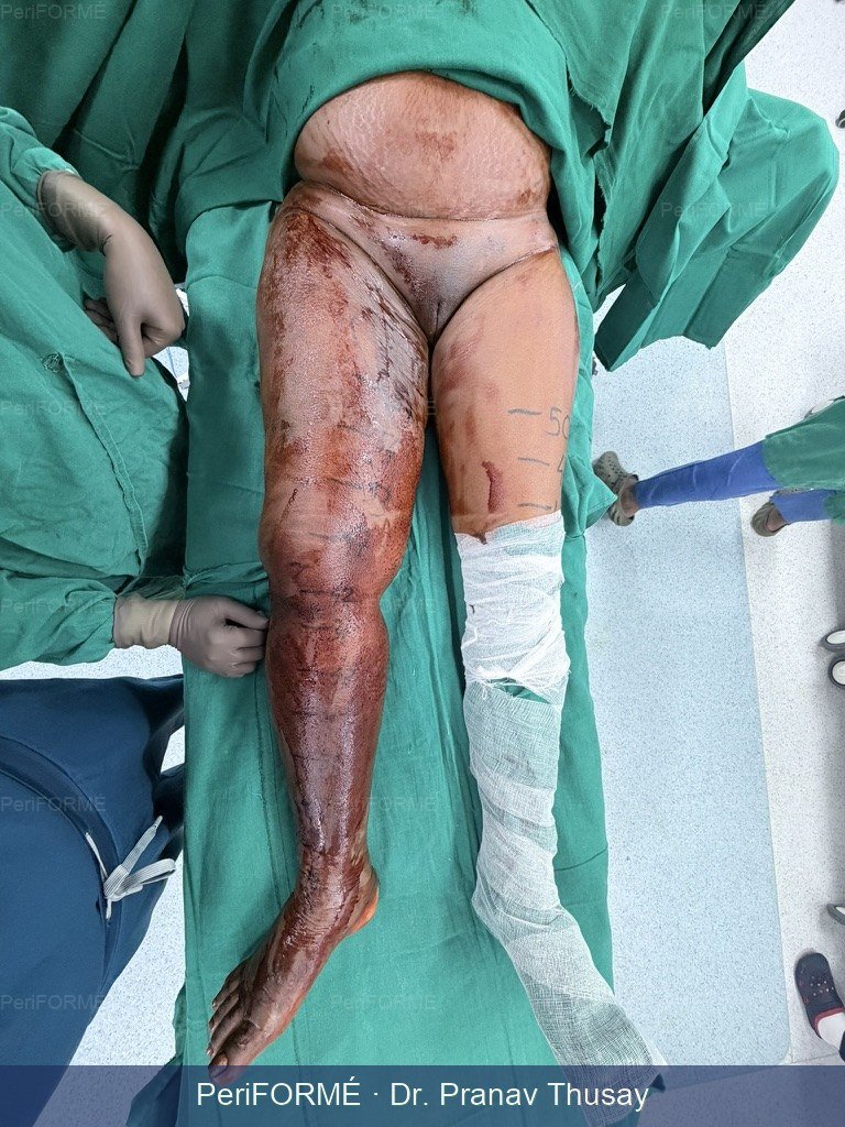 Lymphedema surgery - reduction in lower limb circumference and improvement in quality of life — Before