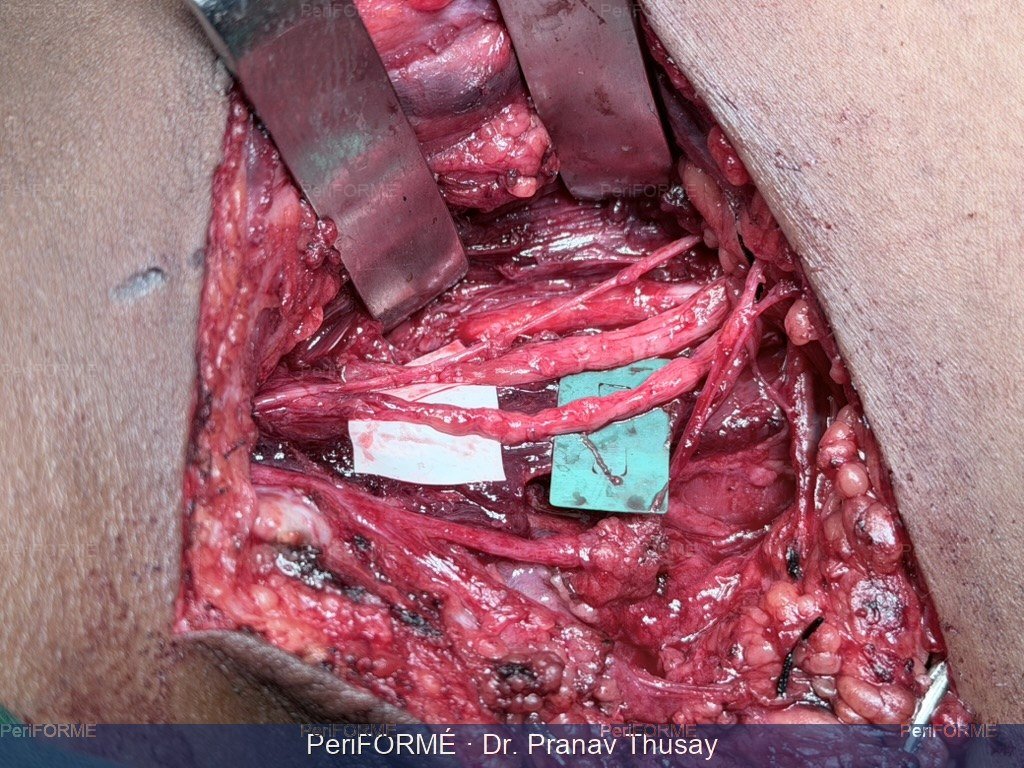Nerve surgery - brachial plexus injury — After