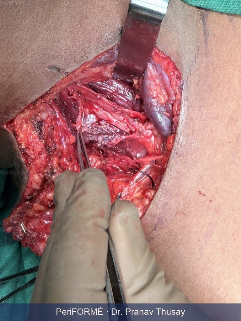 Nerve surgery - brachial plexus injury — Before