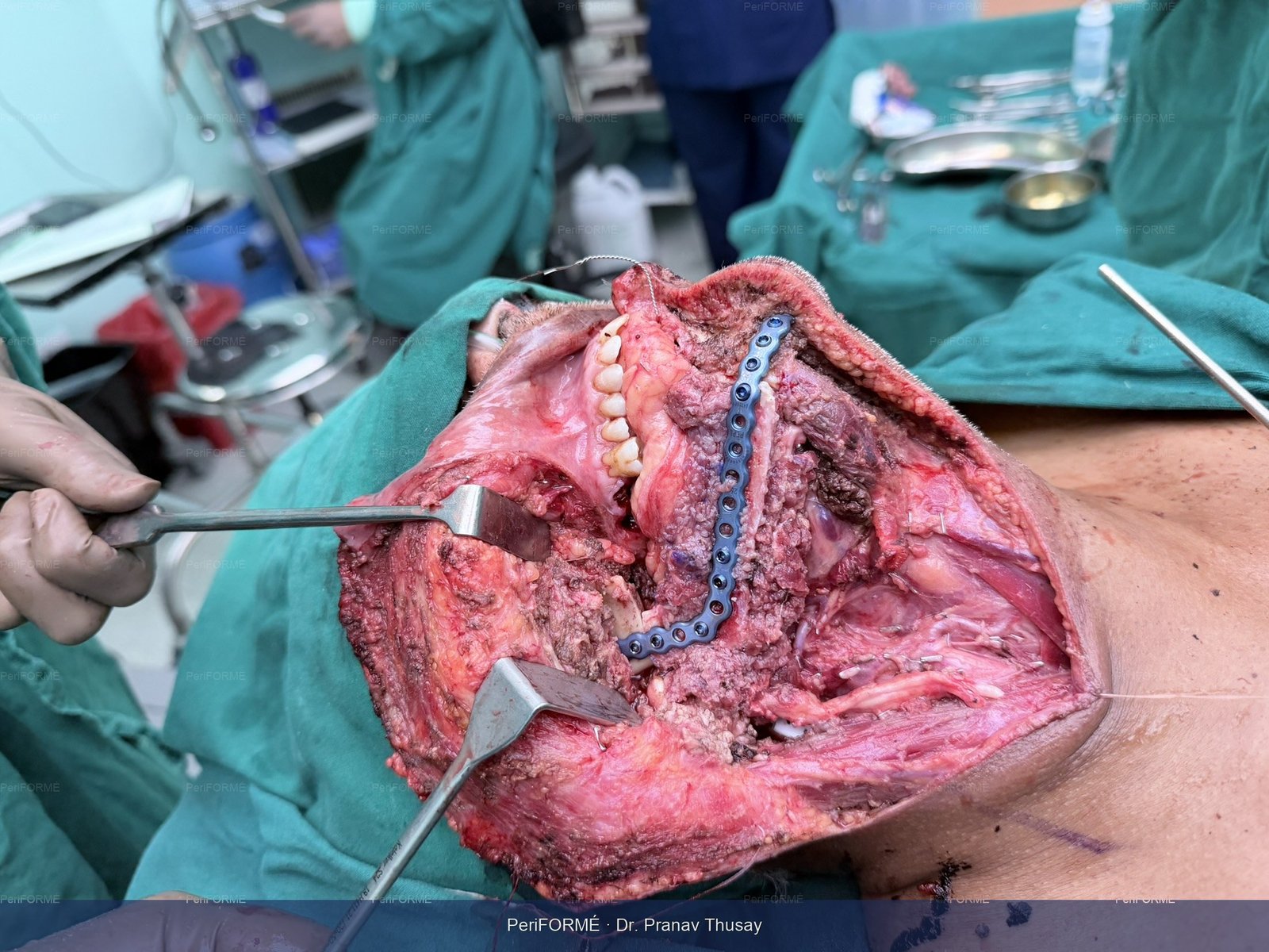 New jaw creation after half jaw removed due to cancer surgery