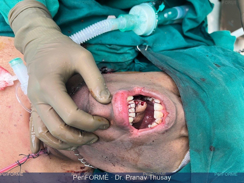 New tongue reconstruction after complete tongue removal after cancer of tongue surgery
