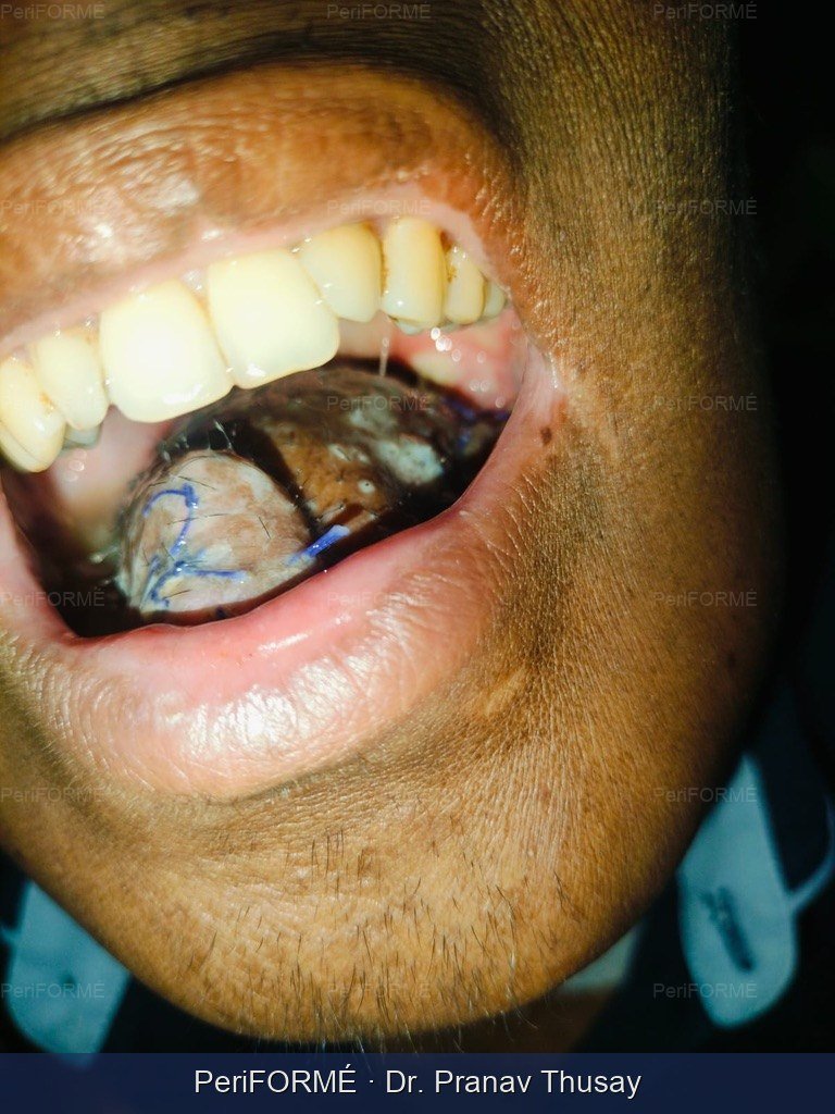 New tongue reconstruction after removal of half o tongue due to cancer