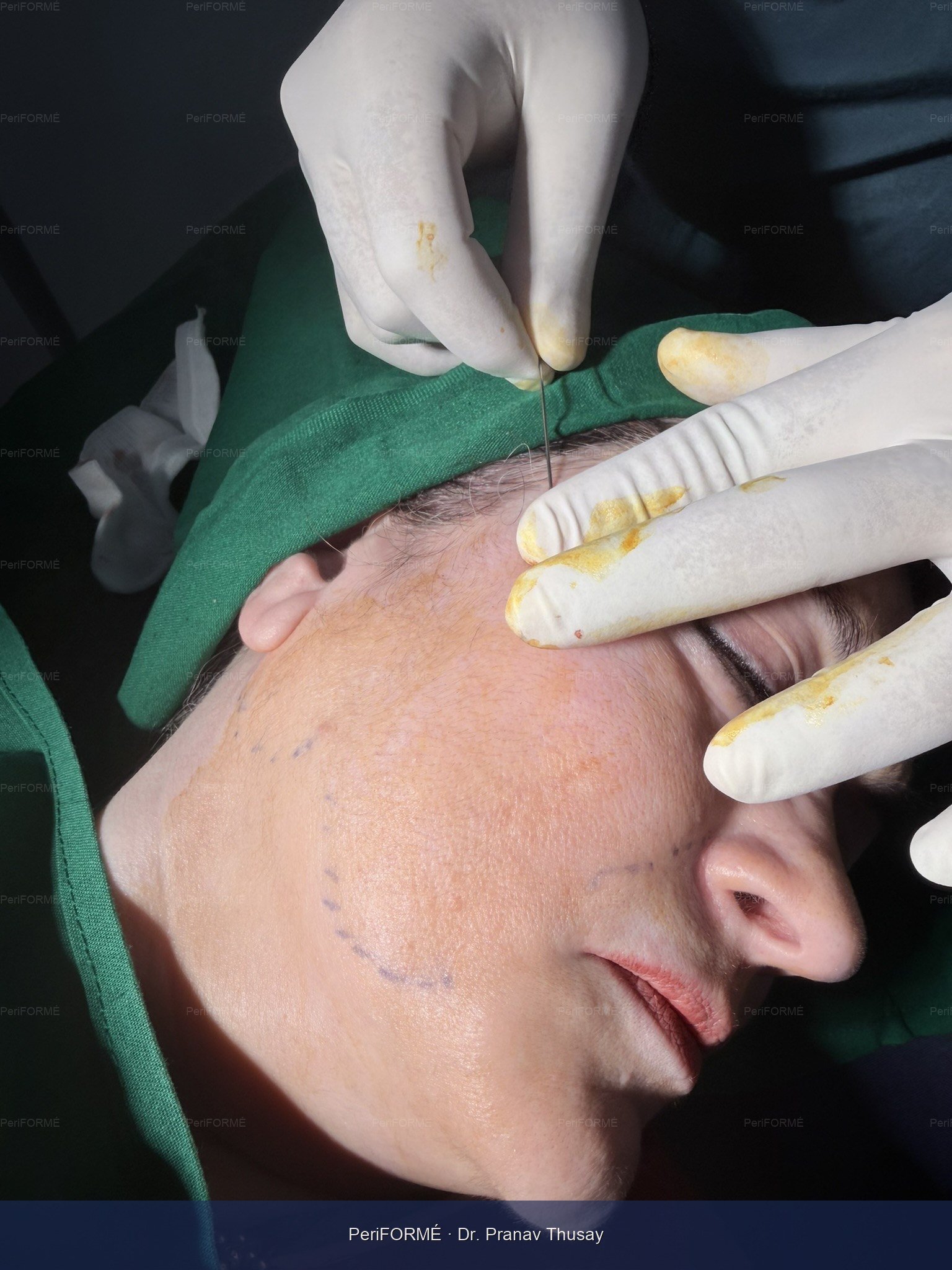 Nonsurgical facelift