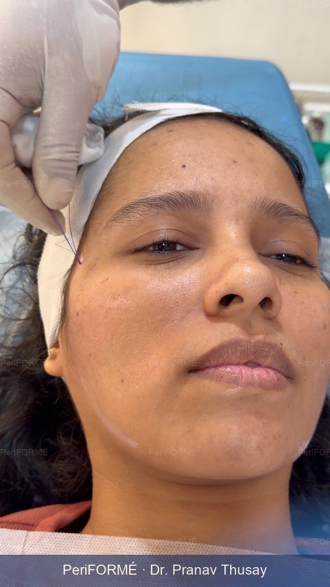 Nonsurgical facelift — After