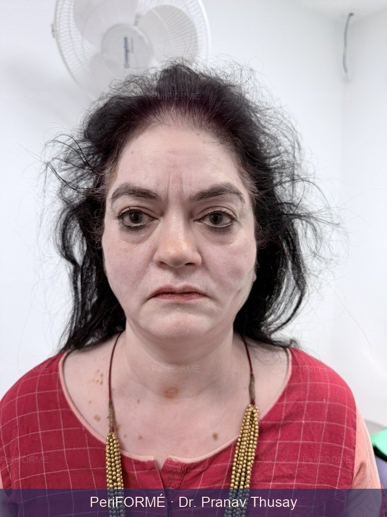 Nonsurgical facelift — After
