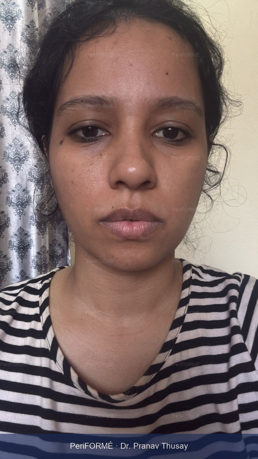 Nonsurgical facelift and Facial rejuvenation — Before
