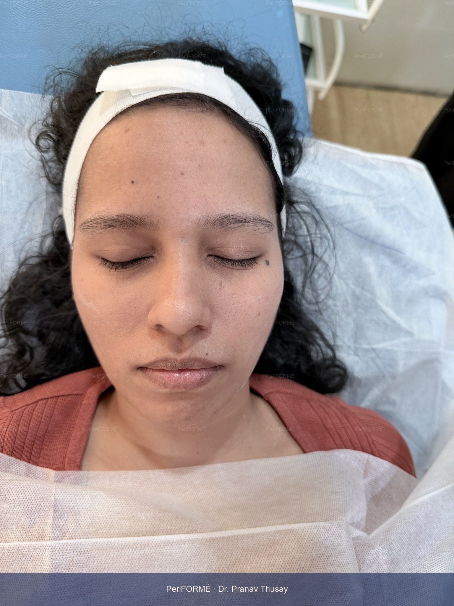 Nonsurgical facelift — Before