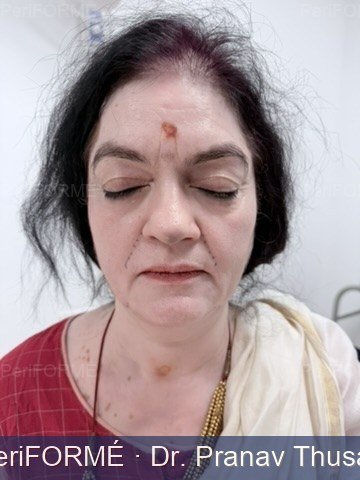 Nonsurgical facelift — Before