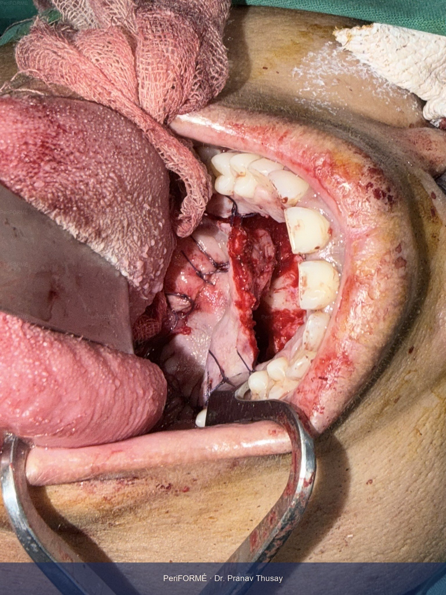 Palate flap reconstruction
