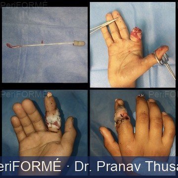 Reimplantation of finger
