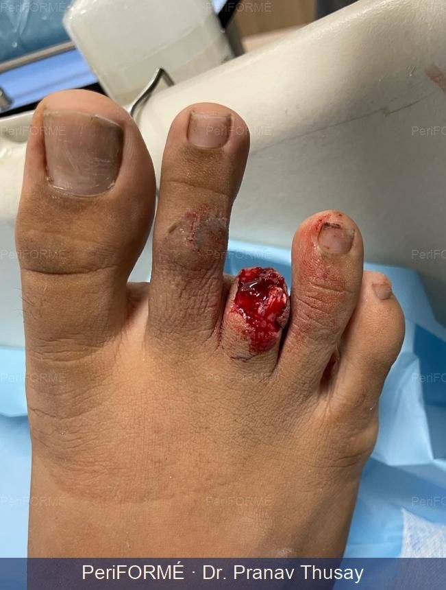 Reimplantation of finger — Before