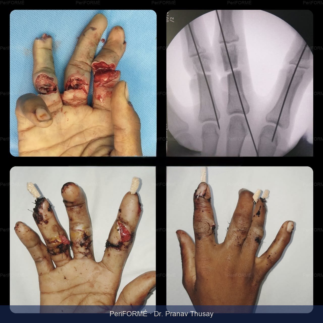 Reimplantation of Fingers