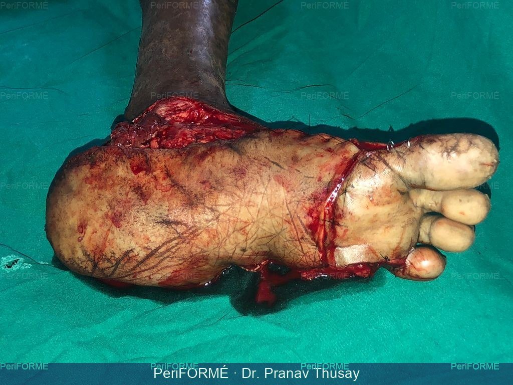 Reimplantation of heel — After