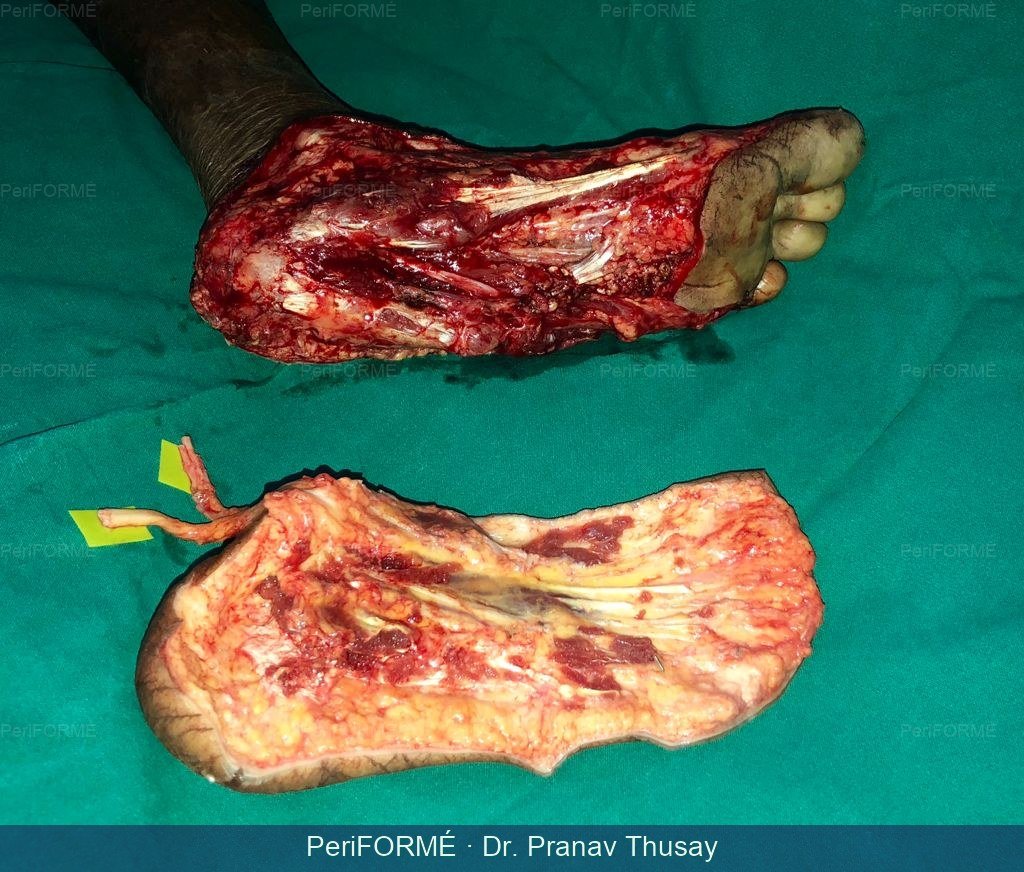 Reimplantation of heel — Before